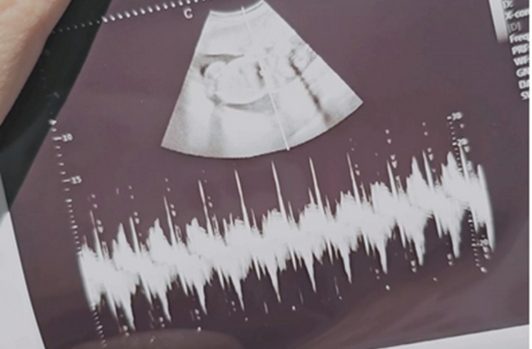 Tangkapan layar USG anak Alyssa Soebandono [Instagram @ichasoebandono]