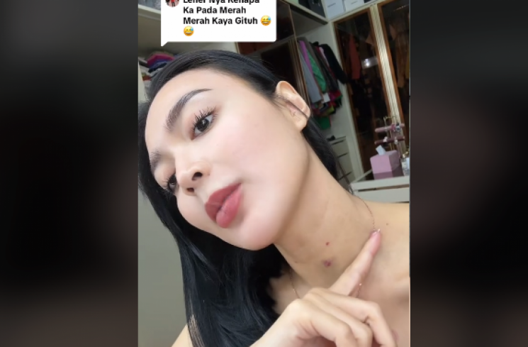 Wika Salim bantah tanda merah di lehernya adalah bekas cupangan. (tangkapan layar/TikTok).