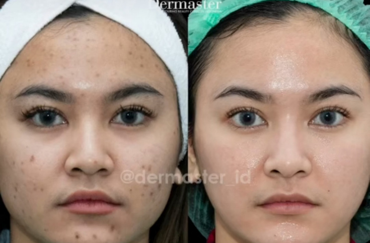 Mahalini [TikTok @dermasterid]