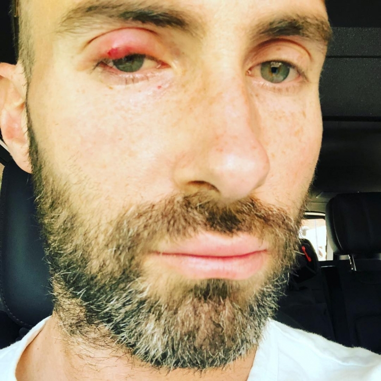 Adam Levine yang sedang sakit bintitan/Instagram @adamlevine.