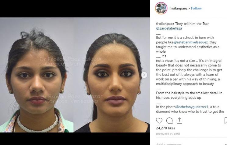 Foto sebelum dan sesudah Sthefany Gutierrez operasi plastik. (Instagram/@froilanpaez)