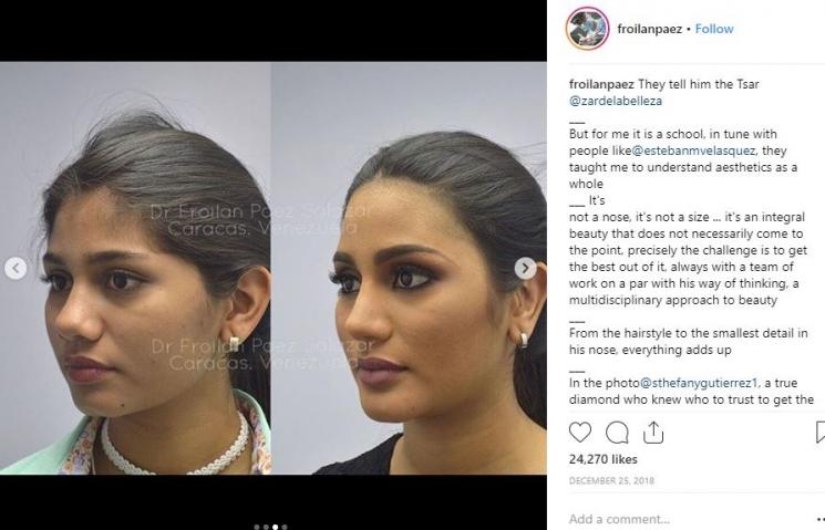 Foto sebelum dan sesudah Sthefany Gutierrez operasi plastik. (Instagram/@froilanpaez)