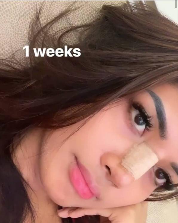 Millendaru diduga lakukan operasi hidung. [Instagram]