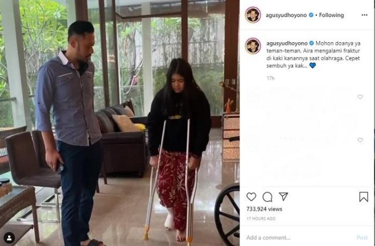 Almira Tunggadewi Yudhoyono mengalami fraktur di kaki kanan (Instagram @agusyudhoyono)