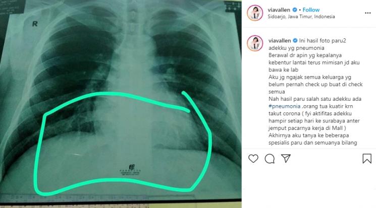 Adik Via Vallen positif Corona. (Instagram/@viavallen)