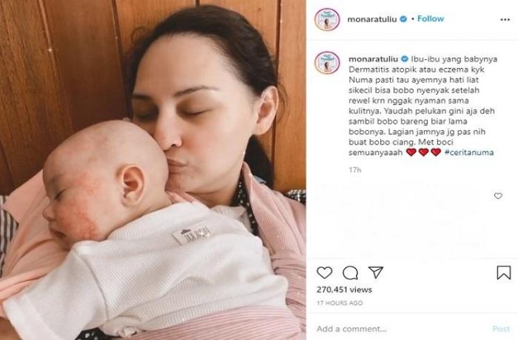 Anak Mona Ratuliu sakit dermatitis atopik (Instagram @monaratuliu)