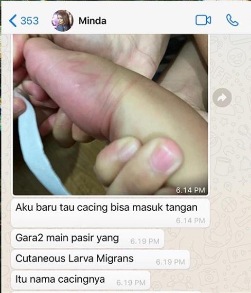 Tangan anak Anji dimasuki cacing Cutaneous Larva Migrans. [capture Instagram @duniamanji]