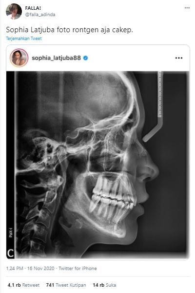 Foto Rontgen Sophia Latjuba (Twitter.com/Falla_Adinda)