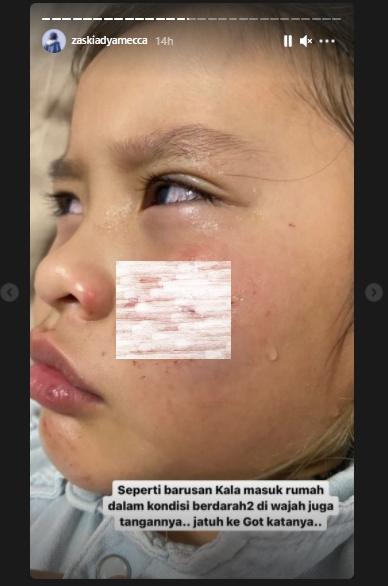 Kala Madali nyemplung got sampai berdarah (Instagram.com/zaskiadyamecca)