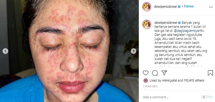 Dewi Perssik tunjukan badan penuh bercak merah (Instagram.com/dewiperssikreal)