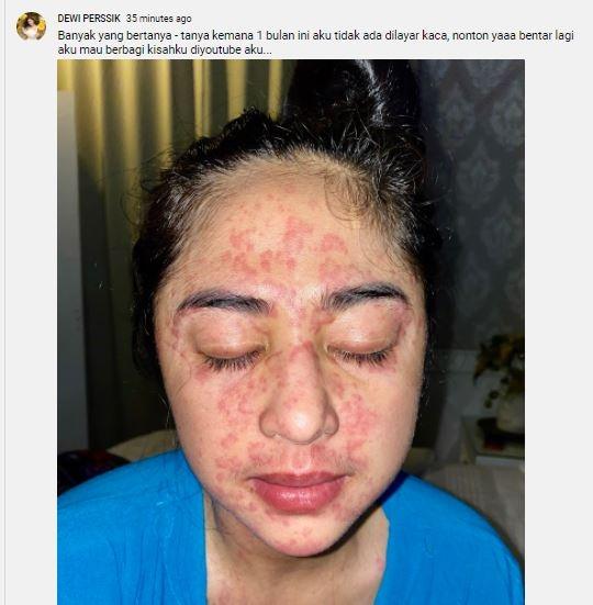 Wajah Dewi Perssik penuh bercak merah. (Youtube/DewiPerssik)