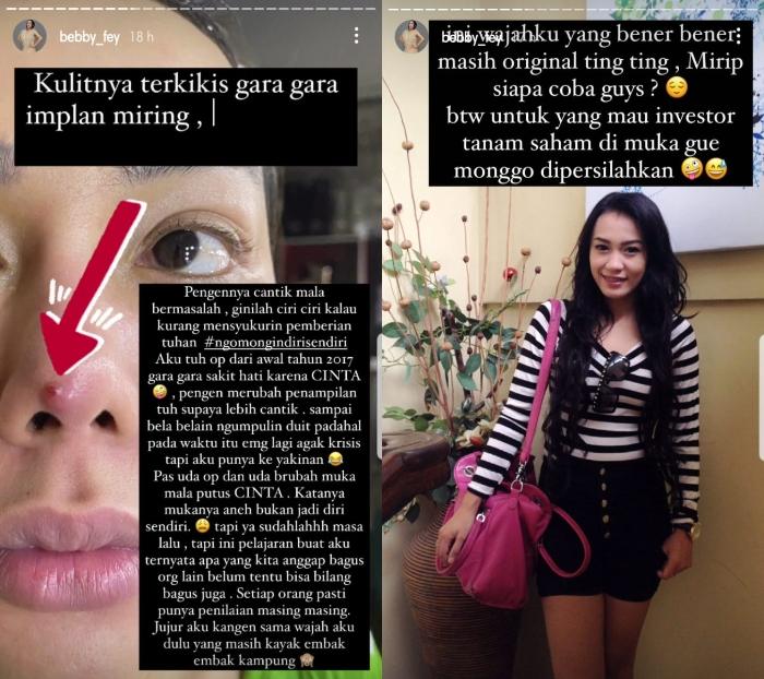 Implan hidung Bebby Fey jebol. (Instagram/@bebby_fey)