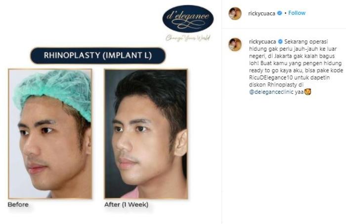 Ricky Cuaca operasi hidung. (Instagram/@rickycuaca)