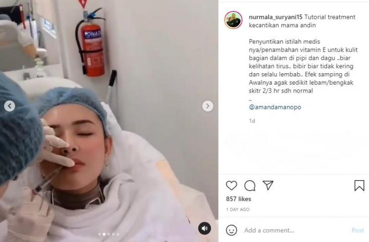 Amanda Manopo suntik bibir, pipi, dan dagu. (Instagram/nurmala_suryani15)