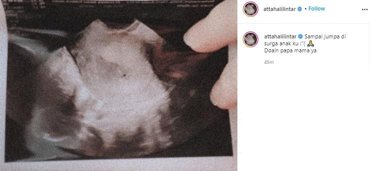 Atta Halilintar kabarkan Aurel Hermansyah keguguran. (Instagram/@attahalilintar)