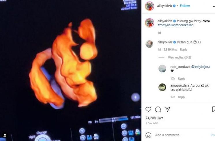 USG calon buah hati Ali Syakieb (instagram.com)