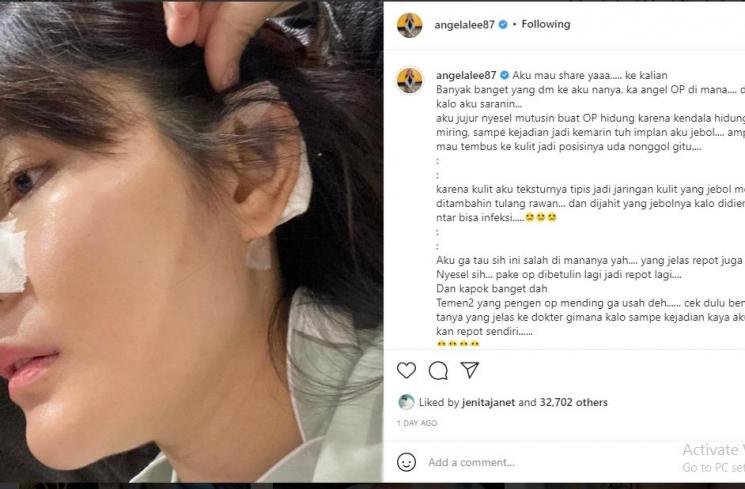 Angela Lee perlihatkan bekas operasi tulang rawan [Instagram/@angelalee87]