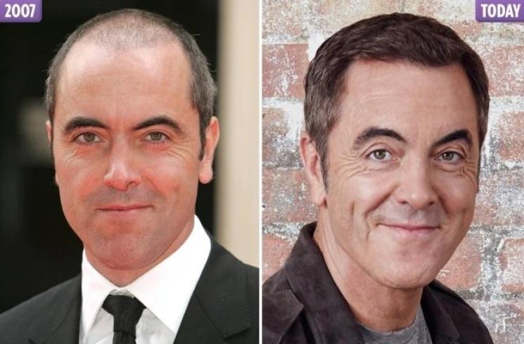 James Nesbitt Artis yang Transplantasi Rambut (thesun.co.uk)