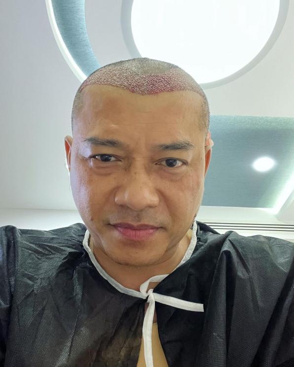 Artis yang Transplantasi Rambut (Instagram/@ananhijau)