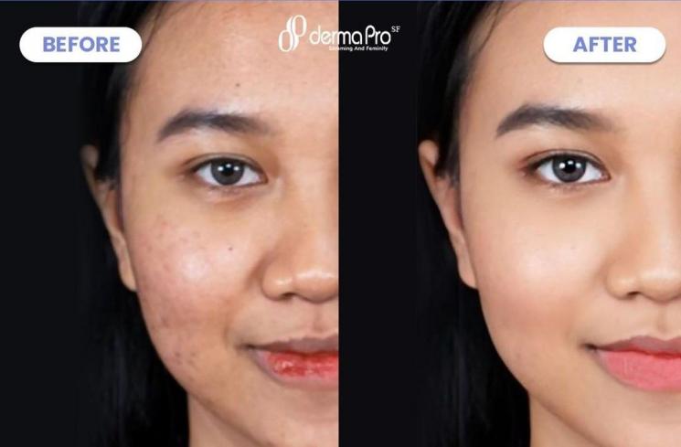 make over Mayang (Instagram/@dermaprosf)