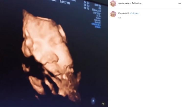 Potret USG anak Aurel Hermansyah. (Instagram)