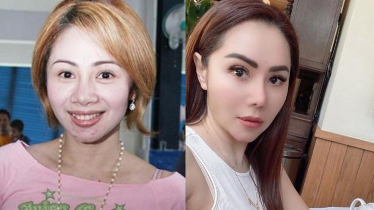 Potret Artis Setelah Operasi Plastik (Instagram/@femmypermatasari)