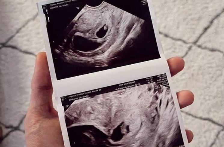 Kronologi Dinda Hauw Keguguran Anak Kembar (Instagram/dindahw)