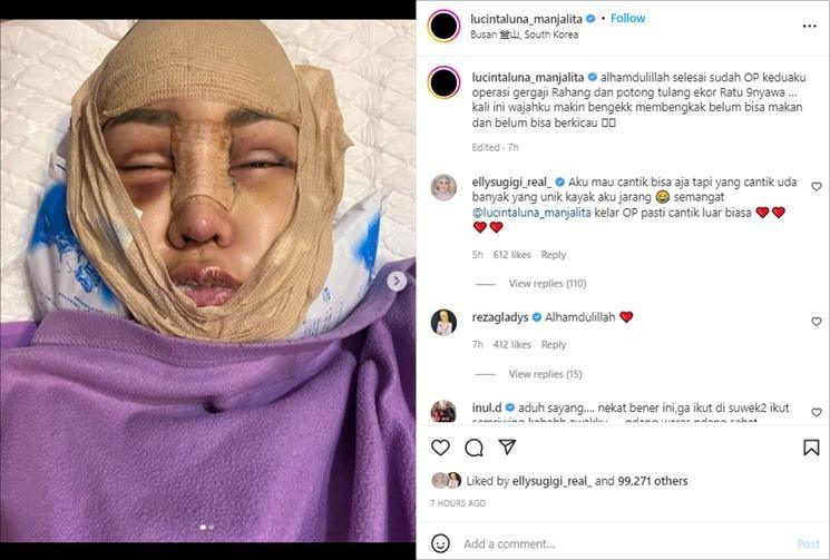 Lucinta Luna unggah foto wajah usai operasi. (Instagram/@lucintaluna_manjalita)