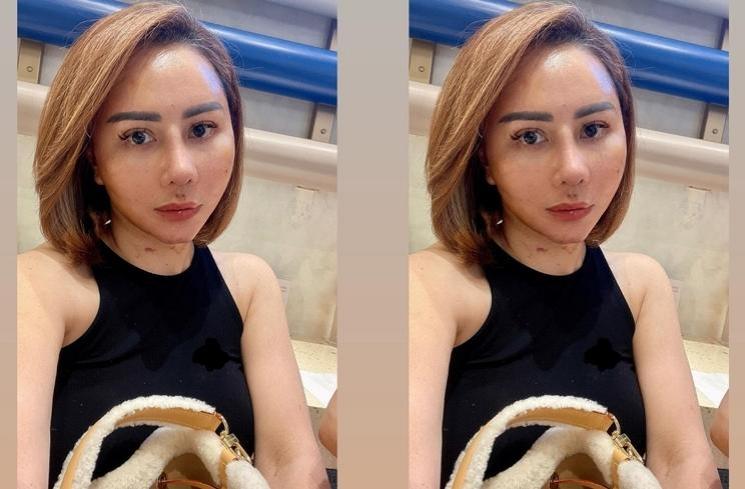 Potret Wajah Femmy Permatasari usai Oplas di Korea (Instagram/@femmypermatasari)