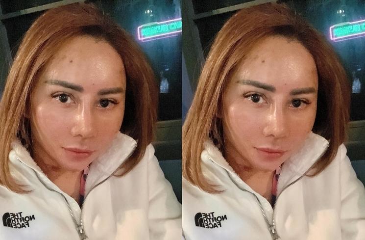 Potret Wajah Femmy Permatasari usai Oplas di Korea (Instagram/@femmypermatasari)