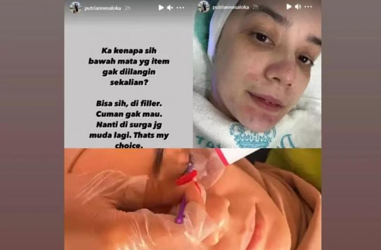 Putri Anne ogah filler hidung, tapi ekstensi bulu mata (Instagram/@tokek_dramaqueen)